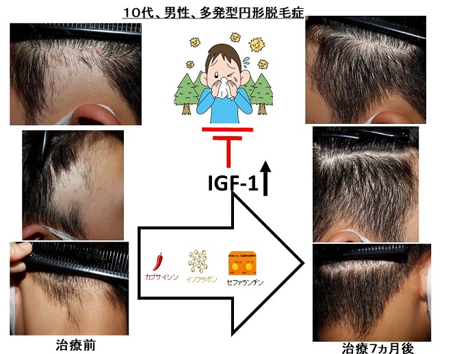 円形脱毛症　病院